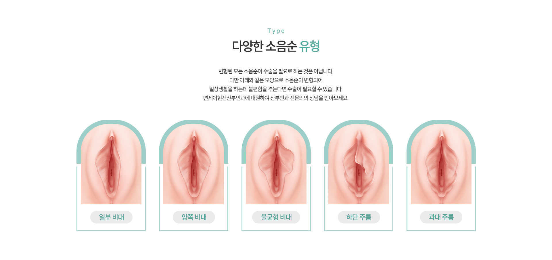 소음순성형 유형
