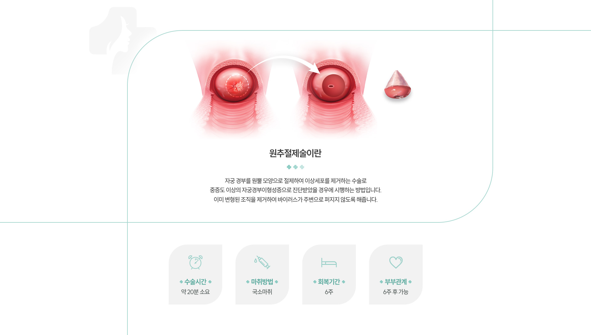 원추절제술 정의